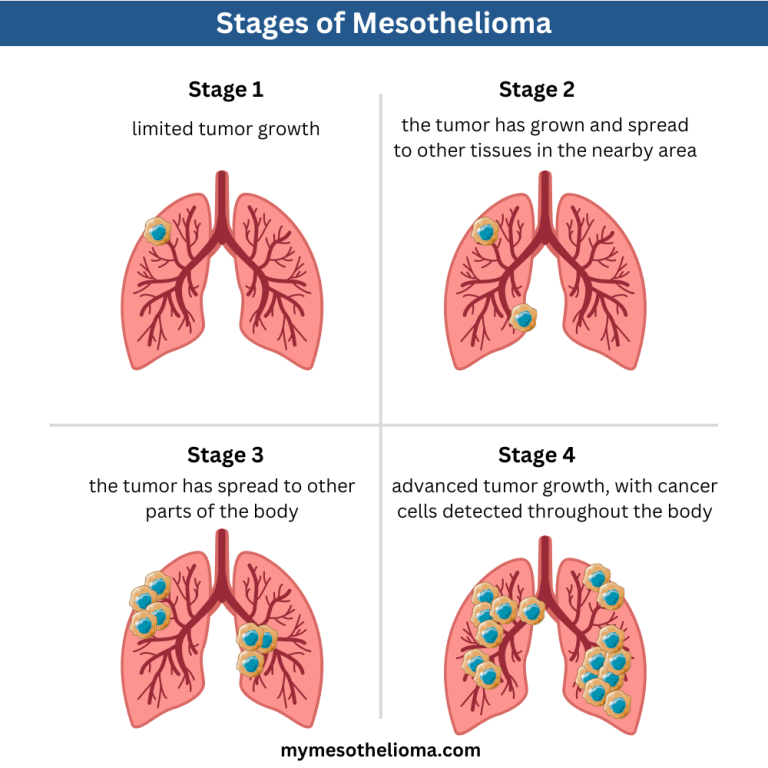 [Study] How Lymph Nodes in Rib Cage Could Help Treatment of Mesothelioma